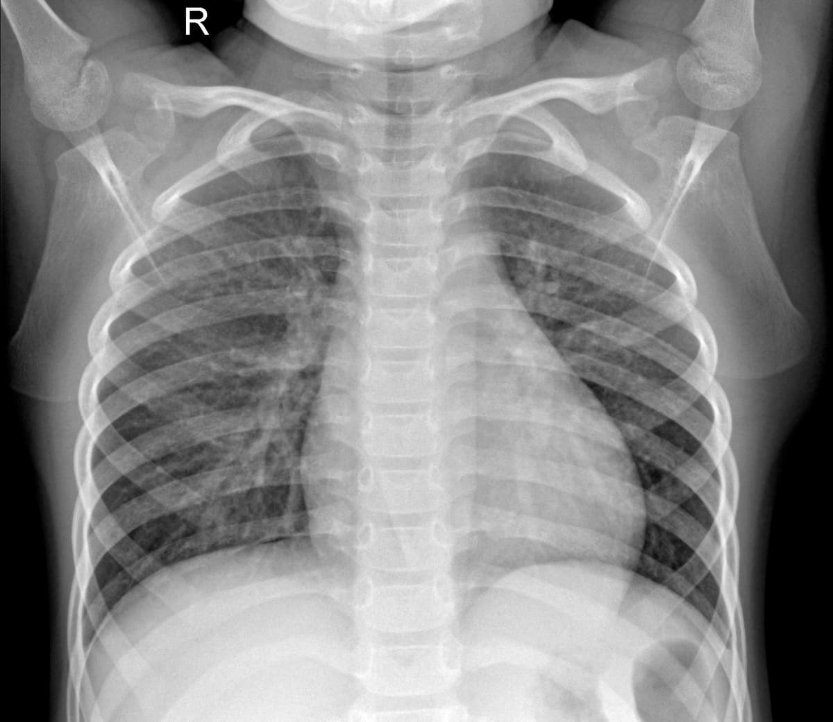 Radiografia Normal — NIH Chest X-ray14