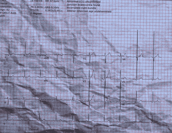 Normal ECG — PTB-XL