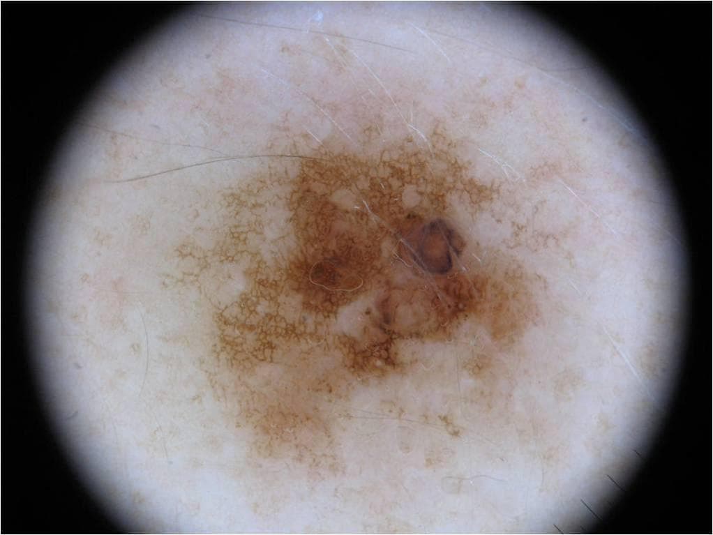 Melanoma — ISIC Archive