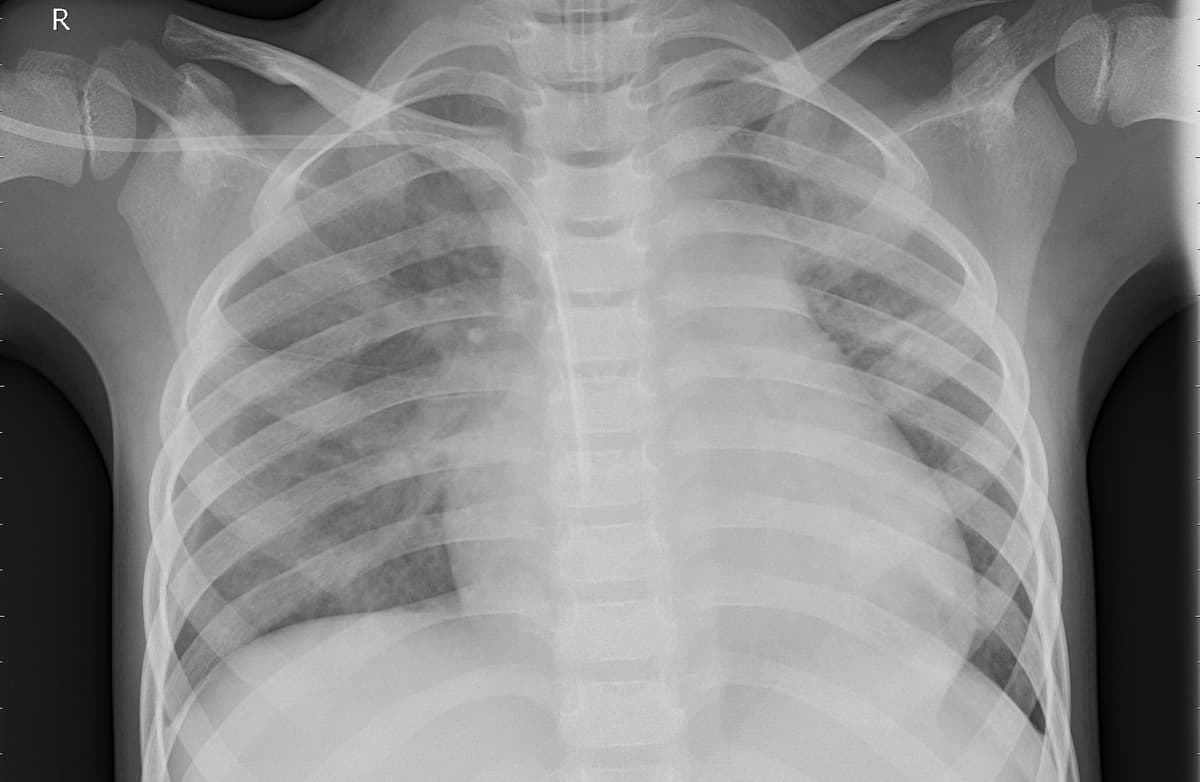 Pneumonia — NIH Chest X-ray14