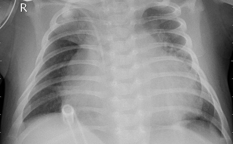 Pneumonia — NIH Chest X-ray14
