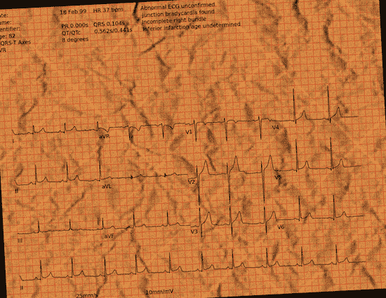 Normal ECG — PTB-XL