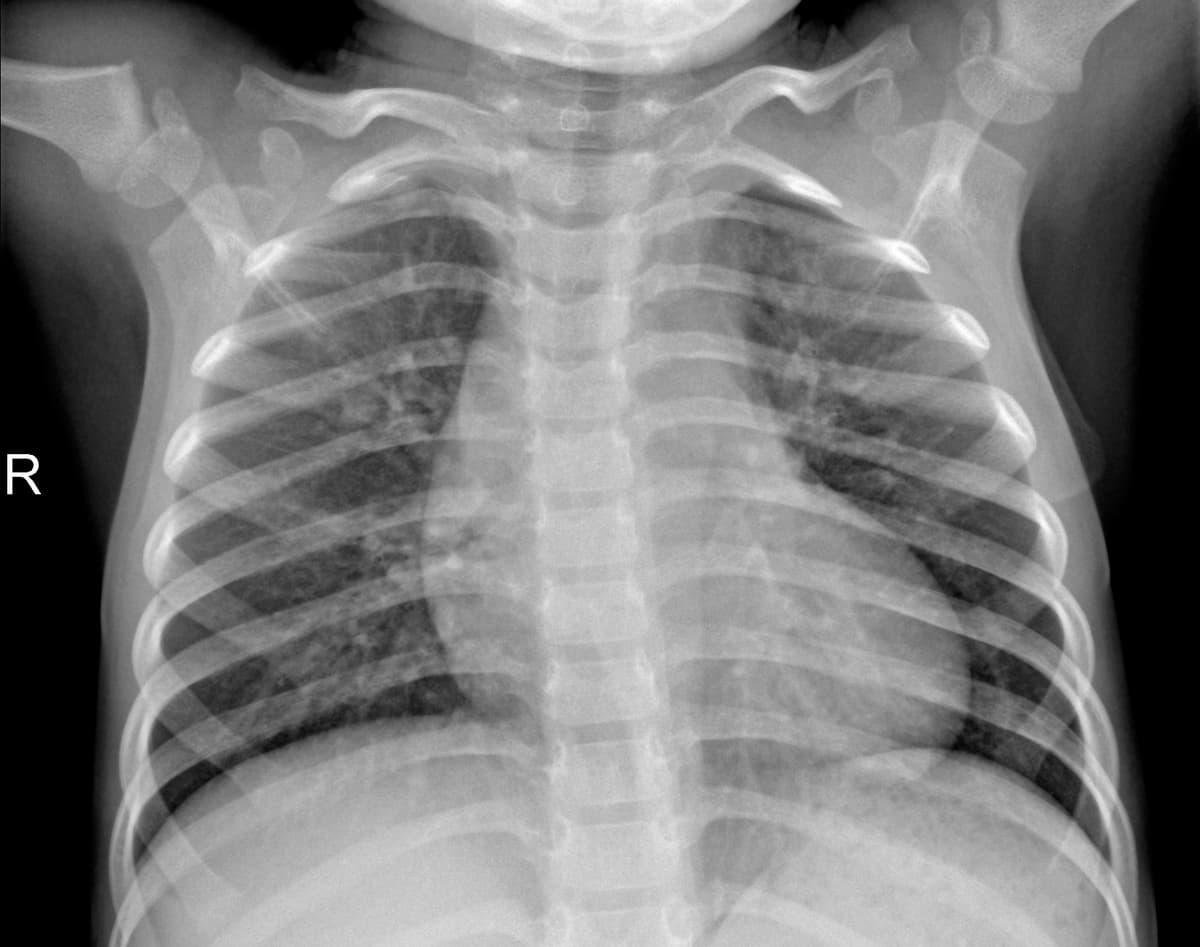Radiografia Normal — NIH Chest X-ray14