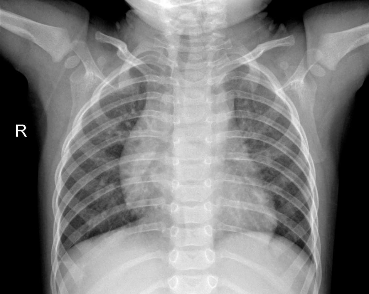 Radiografia Normal — NIH Chest X-ray14