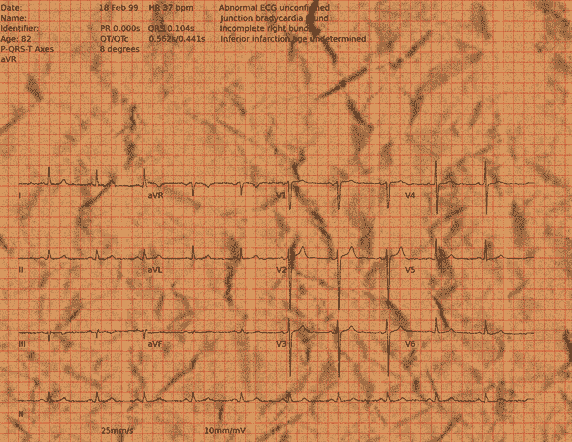 Normal ECG — PTB-XL