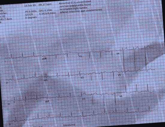 Normal ECG — PTB-XL