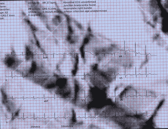 Normal ECG — PTB-XL