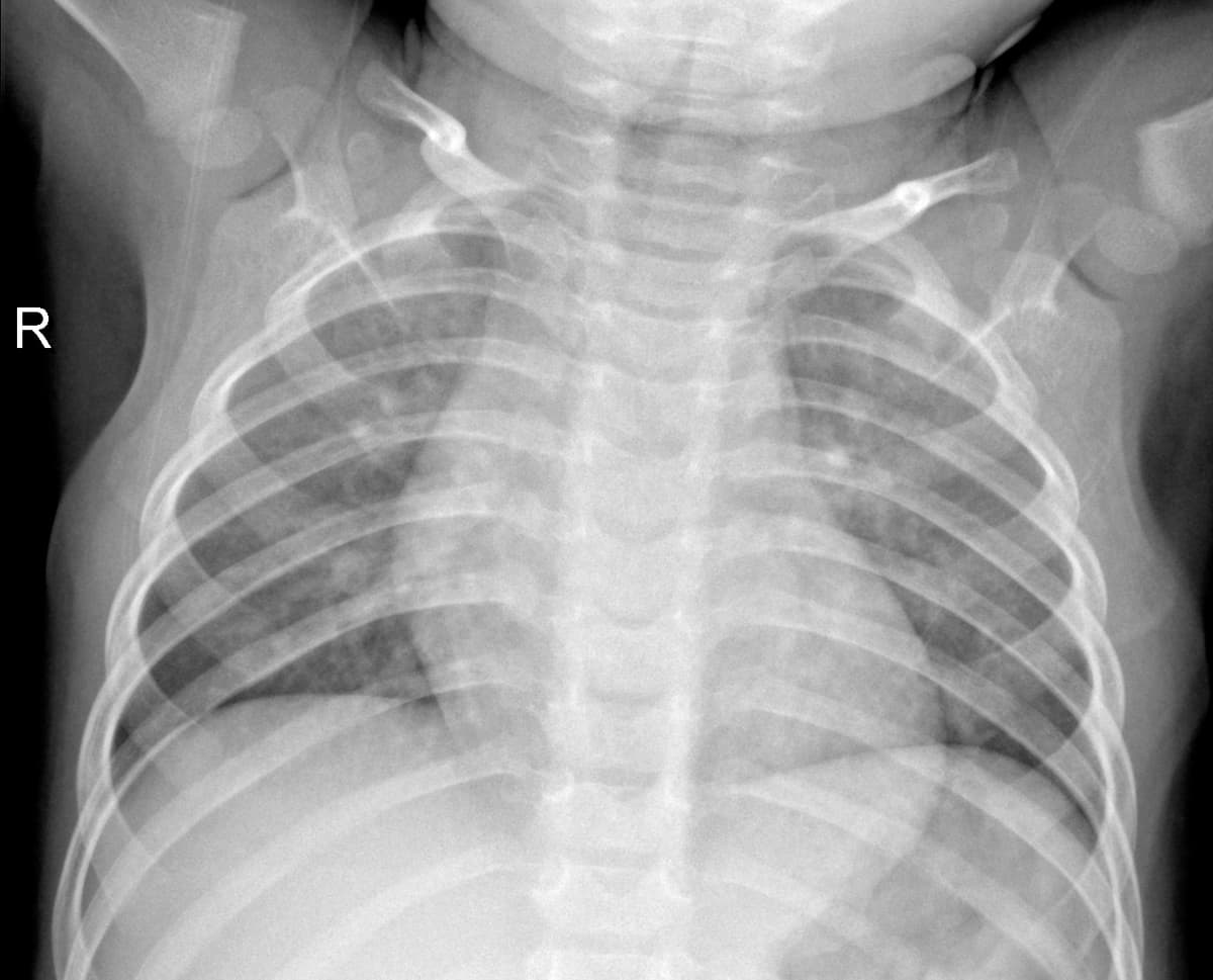 Radiografia Normal — NIH Chest X-ray14
