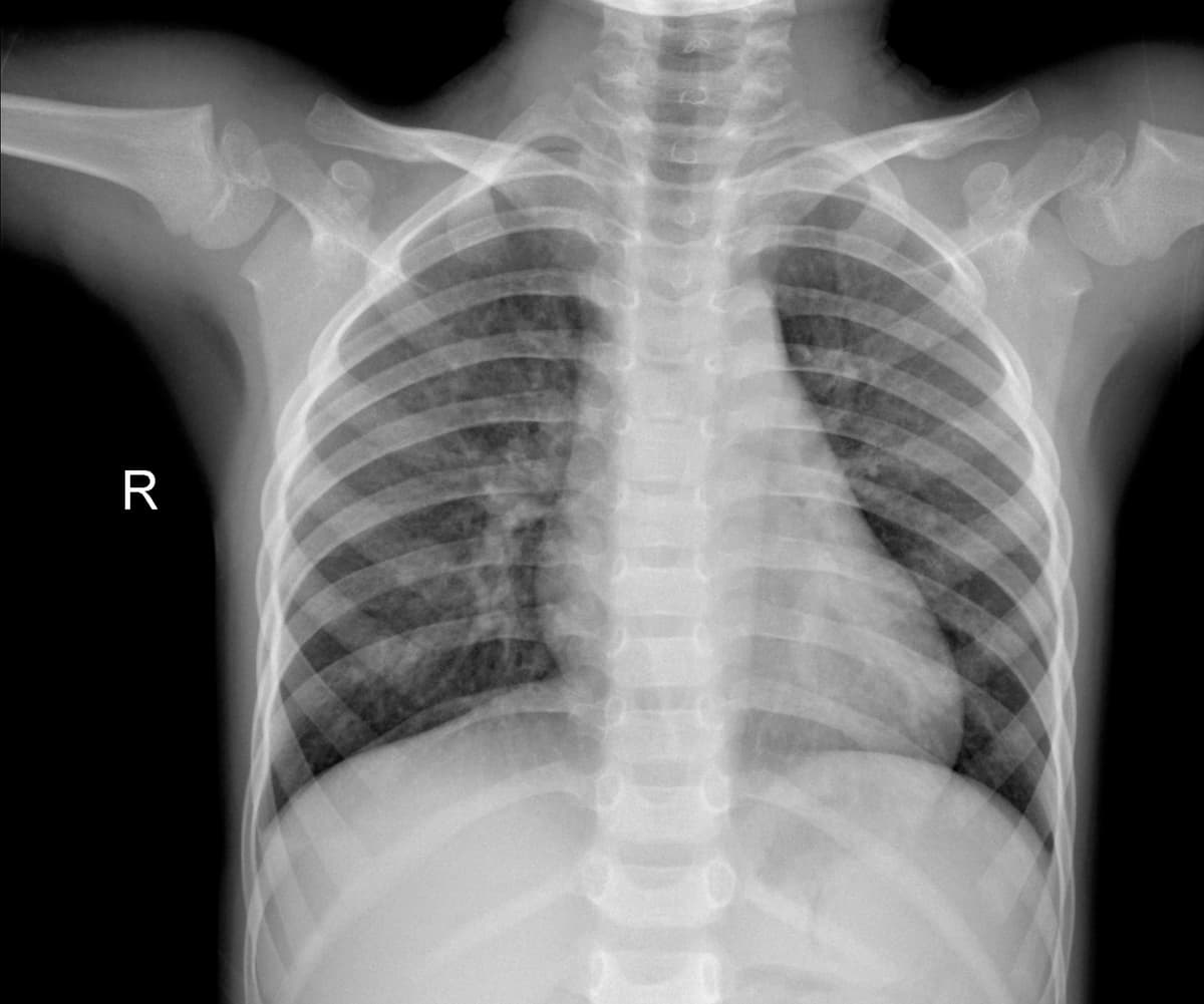 Radiografia Normal — NIH Chest X-ray14
