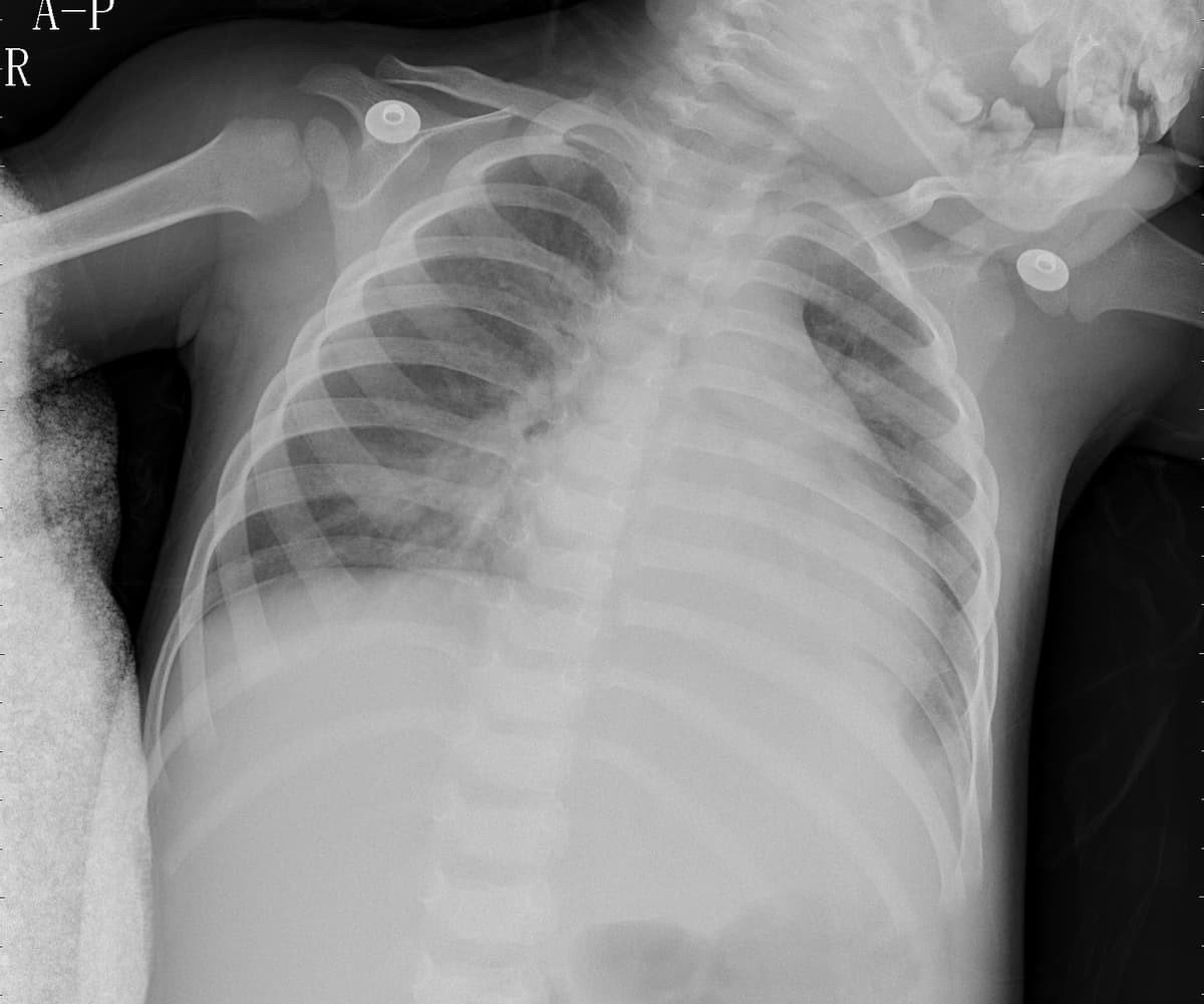 Pneumonia — NIH Chest X-ray14