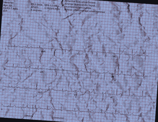 Normal ECG — PTB-XL