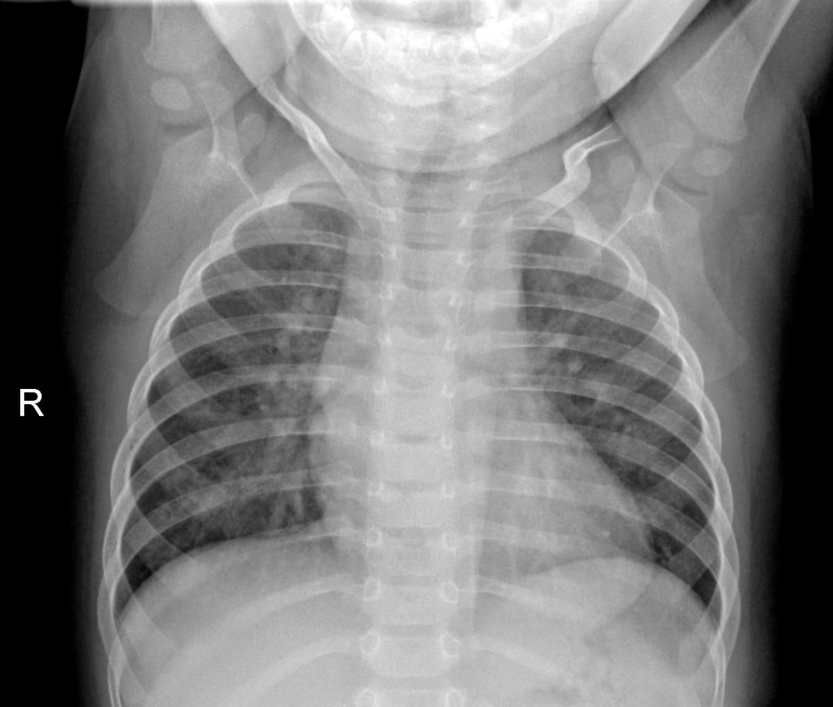 Radiografia Normal — NIH Chest X-ray14