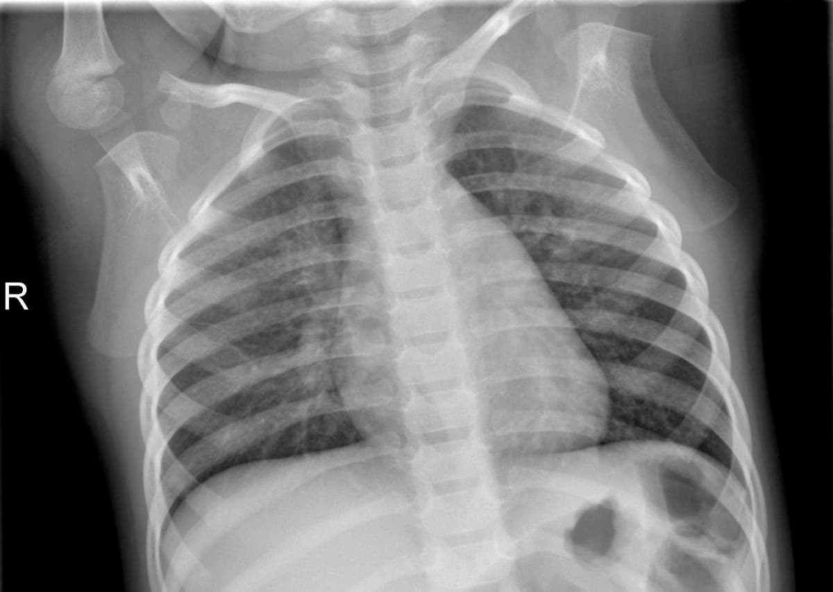 Radiografia Normal — NIH Chest X-ray14
