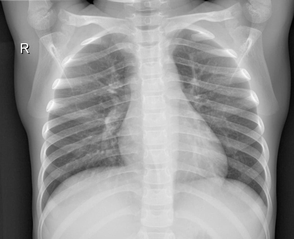 Radiografia Normal — NIH Chest X-ray14