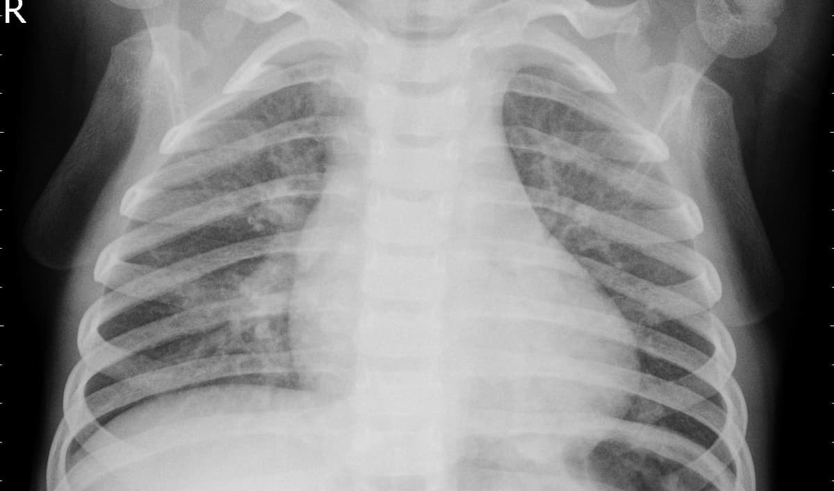Pneumonia — NIH Chest X-ray14