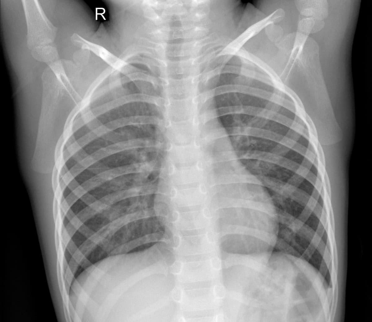 Radiografia Normal — NIH Chest X-ray14