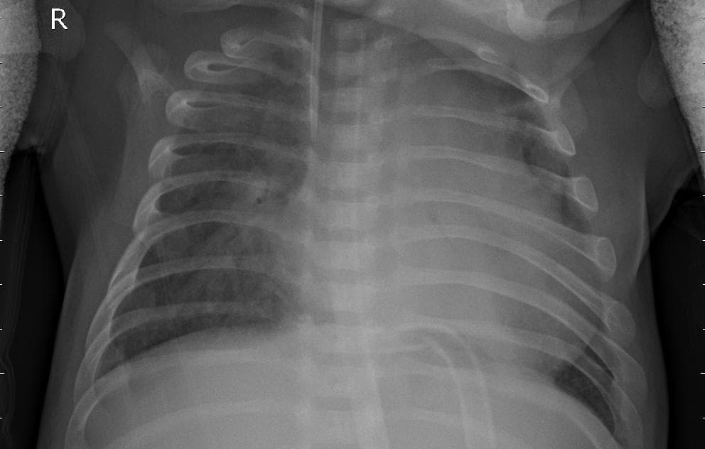 Pneumonia — NIH Chest X-ray14
