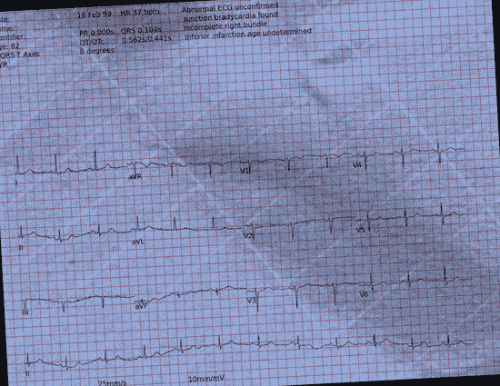 Normal ECG — PTB-XL