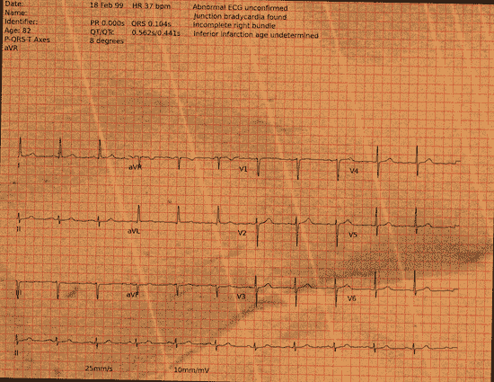 Normal ECG — PTB-XL