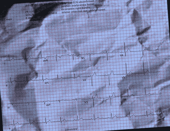 Normal ECG — PTB-XL