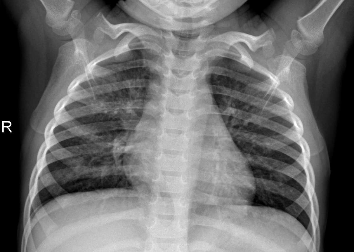 Pneumonia — NIH Chest X-ray14