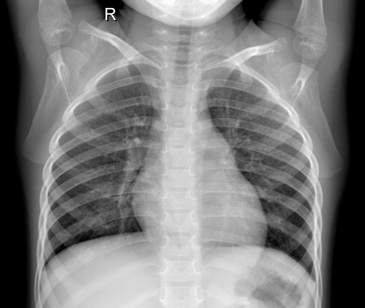 Radiografia Normal — NIH Chest X-ray14