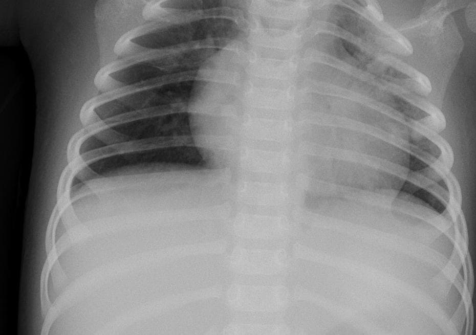 Pneumonia — NIH Chest X-ray14