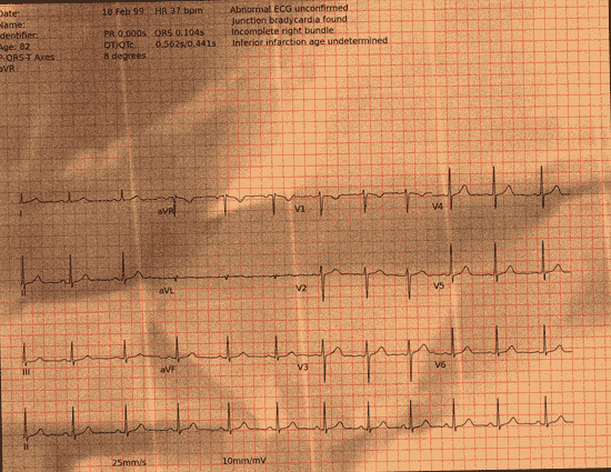 Normal ECG — PTB-XL