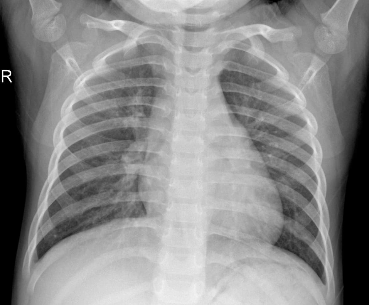 Radiografia Normal — NIH Chest X-ray14