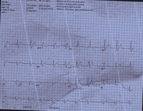 Normal ECG — PTB-XL
