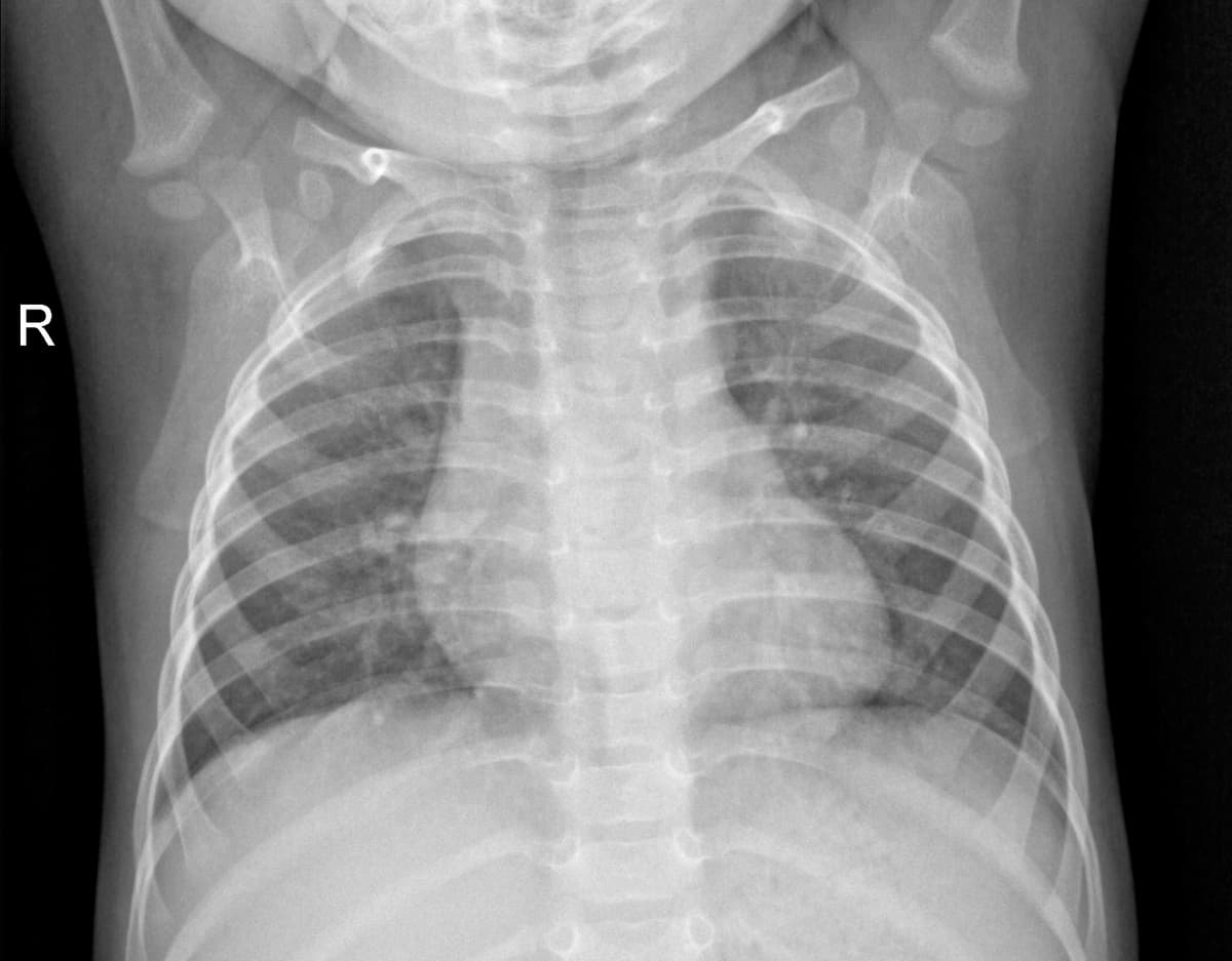 Radiografia Normal — NIH Chest X-ray14