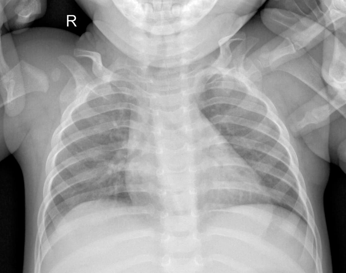 Radiografia Normal — NIH Chest X-ray14