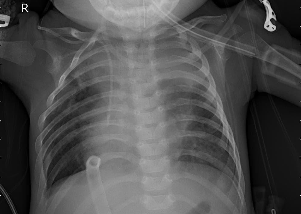 Pneumonia — NIH Chest X-ray14