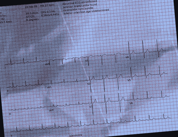 Normal ECG — PTB-XL