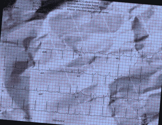 Normal ECG — PTB-XL