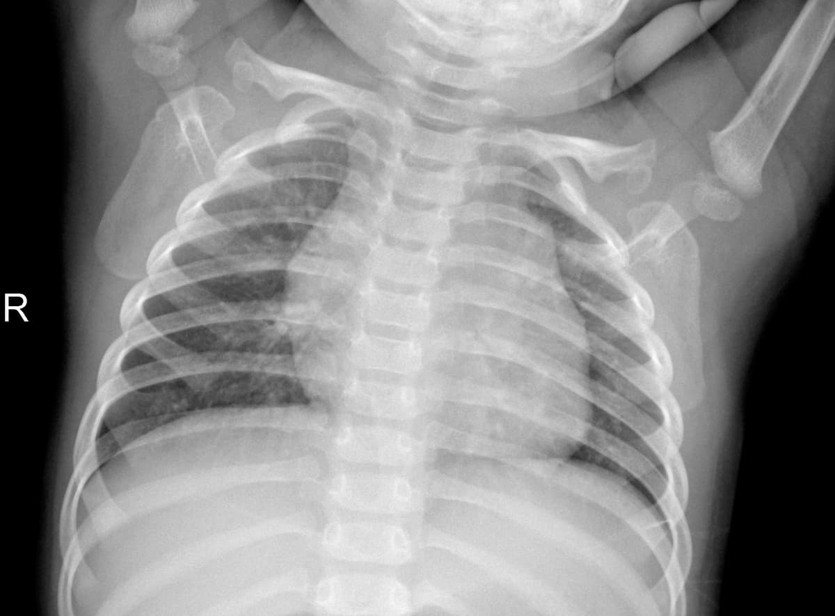 Radiografia Normal — NIH Chest X-ray14
