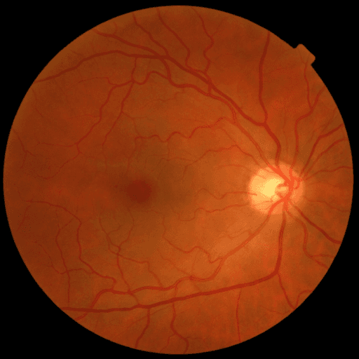 No Diabetic Retinopathy — MESSIDOR-2