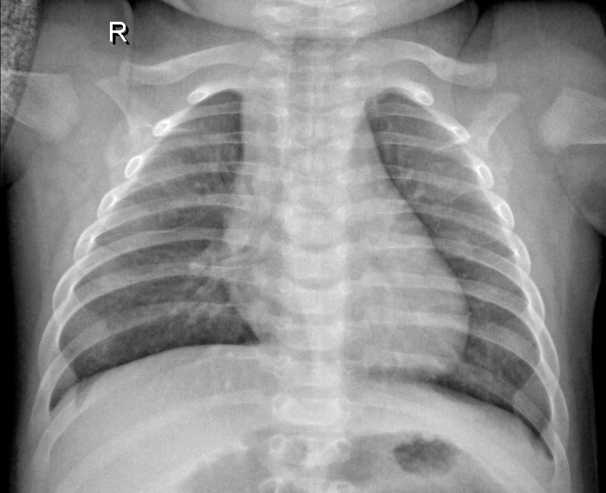 Radiografia Normal — NIH Chest X-ray14