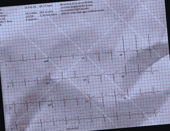 Normal ECG — PTB-XL