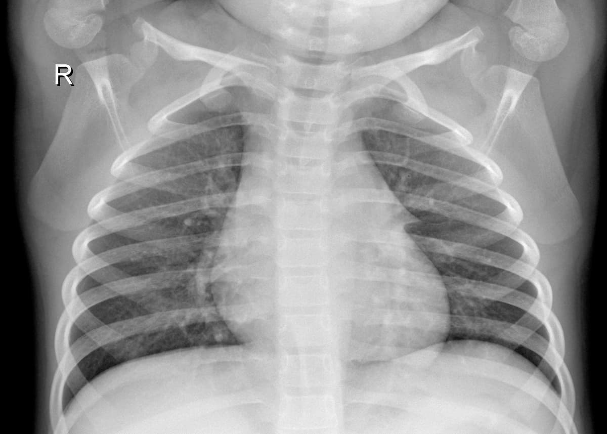 Radiografia Normal — NIH Chest X-ray14