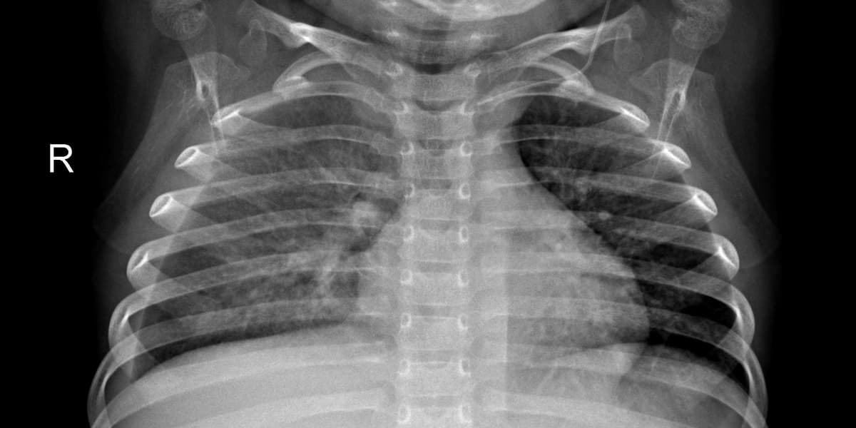 Pneumonia — NIH Chest X-ray14