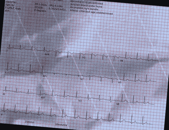 Normal ECG — PTB-XL