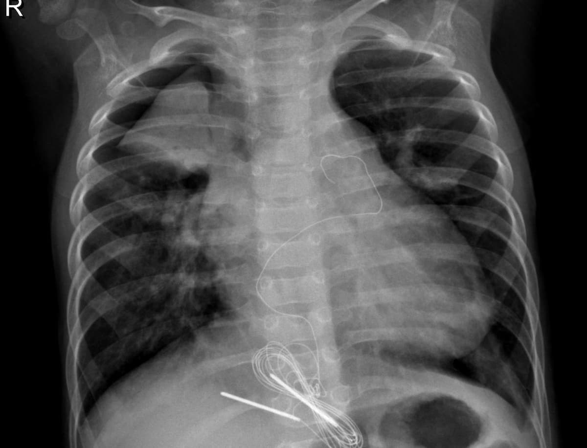 Pneumonia — NIH Chest X-ray14