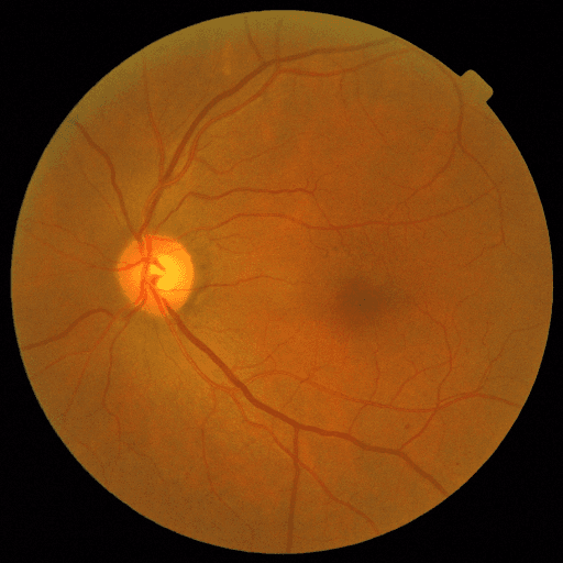 No Diabetic Retinopathy — MESSIDOR-2