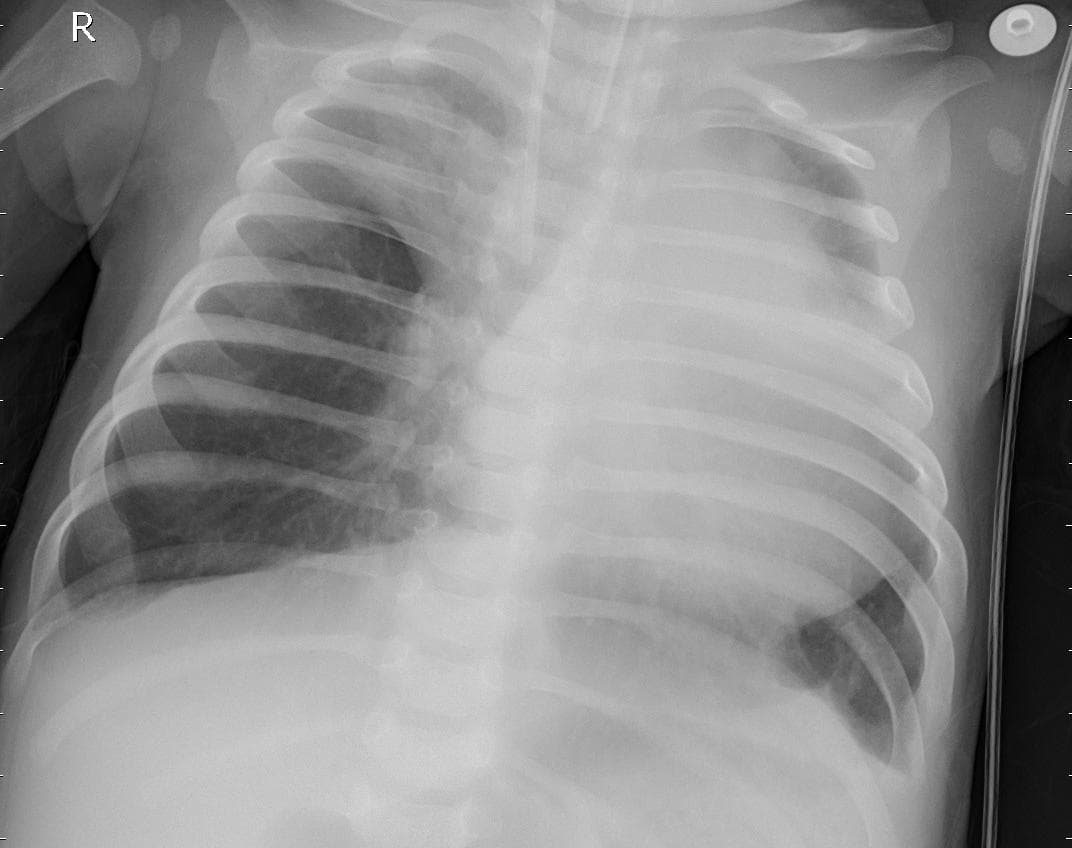 Pneumonia — NIH Chest X-ray14