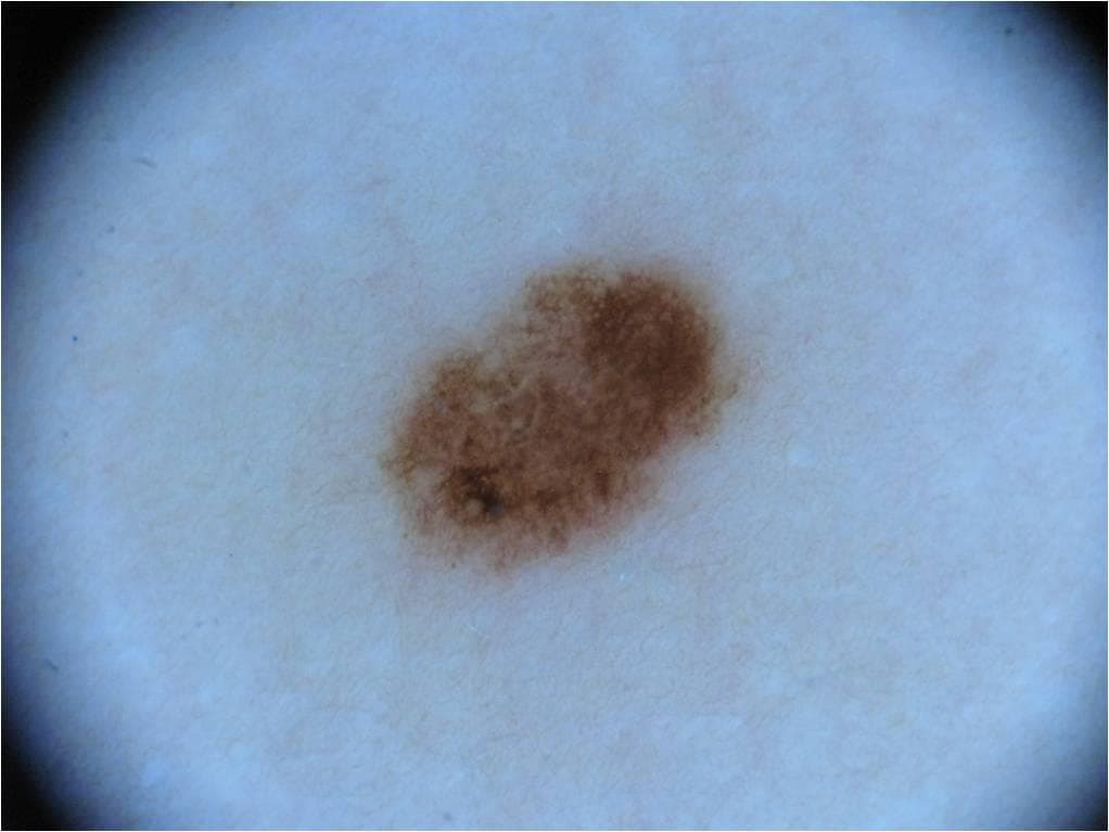 Basal Cell Carcinoma — ISIC Archive