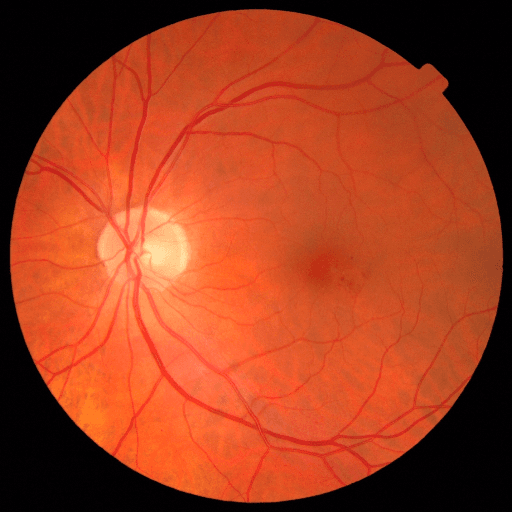 Proliferative DR — MESSIDOR-2