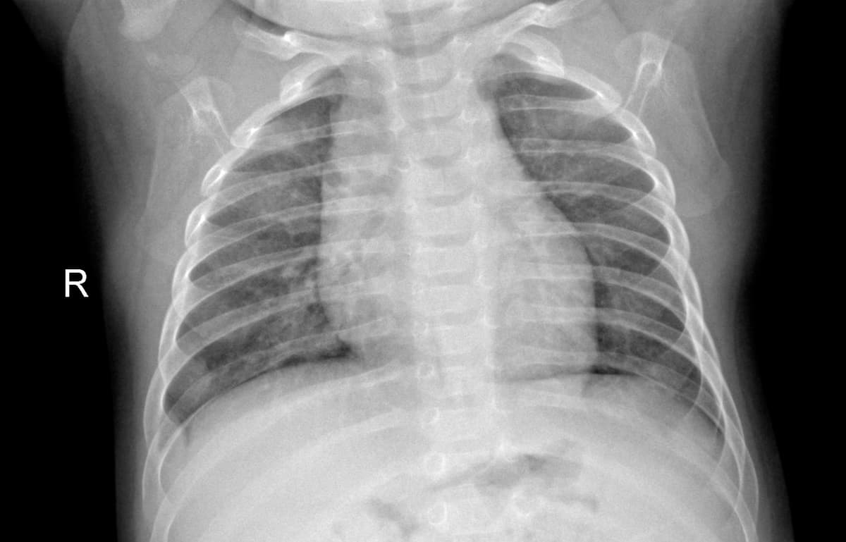 Radiografia Normal — NIH Chest X-ray14