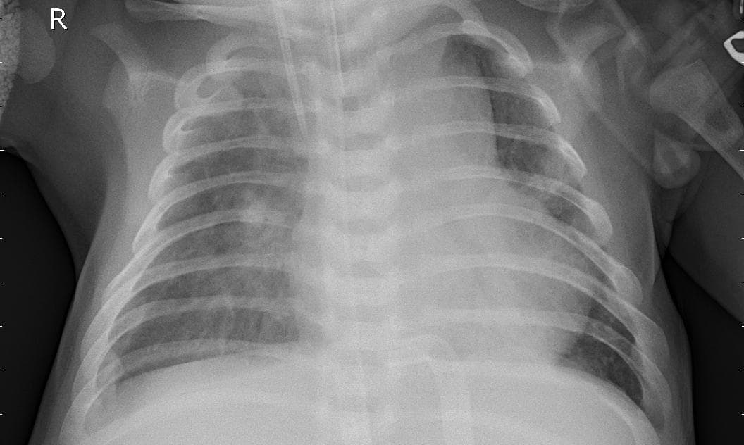 Pneumonia — NIH Chest X-ray14