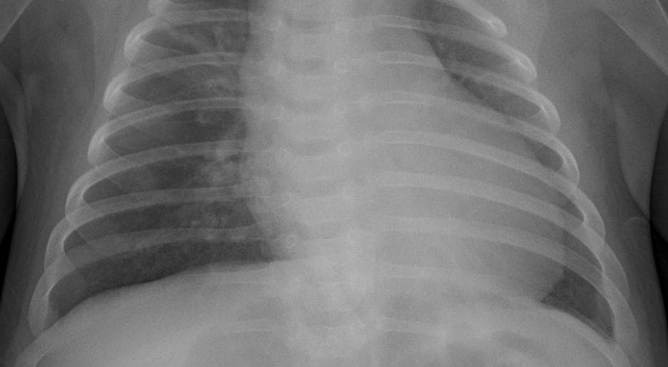 Pneumonia — NIH Chest X-ray14